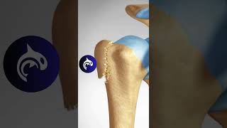 Proximal Humeral Fracture of the Shoulder - #4K #3D #animation