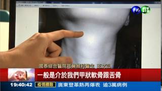 喉嚨有異物感? 當心罹患舌骨囊腫!