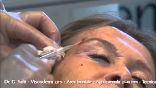 Aplicación VISCODERM 2.0% en Frente. Dr. Giovanni Salti