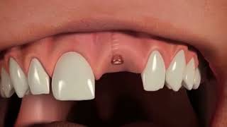 Dental Implants Treatment | Rajan Dental