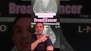 Breast cancer diagnosed on mammogram