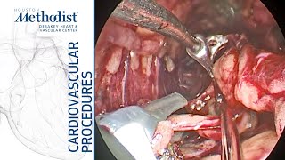 Endoscopic Vein Harvesting for Coronary Artery Bypass Grafting (Reul MD, Zubair MD, Williamson PA-C)