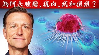 為何長腫瘤、瘜肉、痣和痘痘？基本營養素,自然療法,柏格醫生 Dr Berg