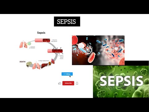 Sepsis | medical coding in tamil | coding in tamil | sepsis | #medicalcoding #sepsis #coding #coding