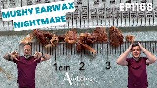 Deep Ear Wax Removal Compilation, Microsuction & Irrigation - EP1169