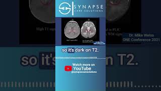 Can you identify the PLIC & CSF on T1 and T2 MRI images
