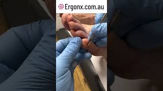 Little toe callus (hard skin) removal by podiatrist this makes the pinky toe more comfortable