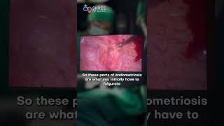When Endometriosis Spreads to the Lungs: A Rare Case Explained! | Dr Jay Mehta, Mumbai