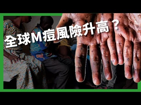 剛果小鎮M痘疫情大爆發！ 全球M痘風險升高？ 錯當麻疹恐延誤就醫？ 【TODAY 看世界｜小發明大革命】