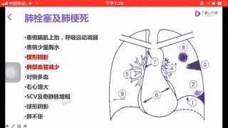 肺充血/肺淤血/肺水腫/肺梗死///胸片閱片技巧之十八