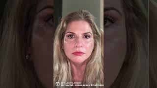 Before & After Suria Plastic Surgery. #drshashikusuma #facedrofsouthfl #facelift #necklift #rha