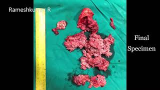 NDVH for 18 -20weeks size degenerated cervical fibroid with previous 2 LSCS