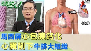 馬西屏心包膜鈣化 心臟削下牛排大組織九死一生 健康2.0