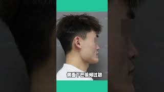 25岁研一学霸想瘦脸！你见过同款的脸型吗？？？？ #变美 #方脸 #案例分享 #下颌角 #整容