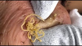 Blackhead Removal: Satisfying  Routine | 122