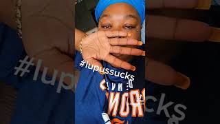 Lupus Sucks #lupus #lupussurvivor #lupuswarrior