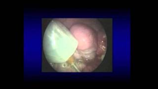 SS10 Instrumentation / Ergonomics: S052 MINIATURE SURGICAL ROBOT FOR LAPAROENDOSCOPIC COLECTOMY