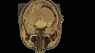 Colorado woman donates body to science for digital cadaver project