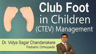 Hi9 | Club Foot in Children (CTEV) Management | Club foot | Dr.Vidya Sagar Chandanakere | Pediatric