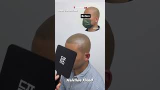 客人所做範圍:植髮疤痕額頭髮際線 全頭頂連髮旋兩邊髮側連的水位後腦後頸線條