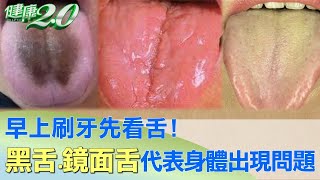 早上刷牙先看舌！ 黑舌.鏡面舌代表身體出現問題 健康2.0
