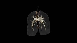 MAPCAs #anatomy #ctscan #medical #angiography #septal #biology #ctangiography
