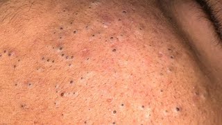 Best Pore Cleaning ASMR - Blackhead & Whitehead Removal, Facial Care Solutions