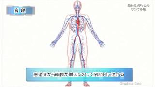 化膿性関節炎／2分で分かる医療動画辞典　ミルメディカル