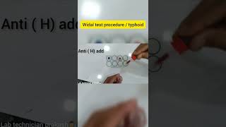 Widal Test Procedure !! typhoid Test #widaltest #typhoid #shorts #short #viral #typhoidfever #doctor