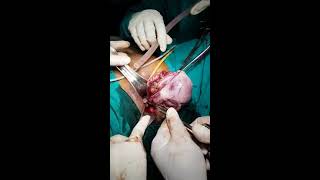 Ovarian cyst removal by vaginal route  at NDVH