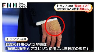 トランプ大統領「慢性静脈不全」診断…足に“むくみ”もホワイトハウス「極めて良好な健康状態」