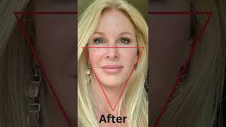 Dr. Amir Karam's Vertical Restore Facelift is the KEY to a YOUTHFUL APPEARANCE!