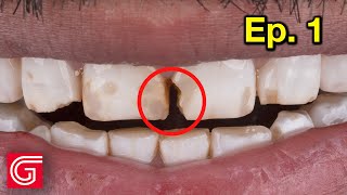 Treating ENAMEL HYPOPLASIA in The ANTERIOR | Ep1