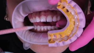 Como fazer um Mockup Dental com Luxatemp Star – Testado e Aprovado!