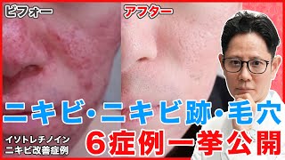 【毛穴/ニキビ/ニキビ跡】どんな症状でも諦めないで。症例をご紹介します