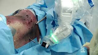 Robotic Simultaneous Lateral Posterior - Avery Buchholz, MD, MPH