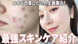 【ニキビ肌必見】ニキビ改善したおすすめアイテム紹介！
