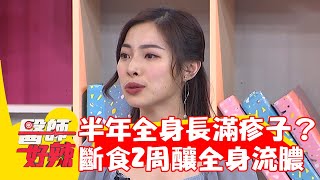 36歲女半年全身長滿疹子！斷食2周反釀全身流膿？！【#醫師好辣】20230916 EP1566 part4