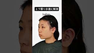 【エラを削るとこんなに変わる】#エラ #アーククリニック＃美容整形#ロゴボ#骨切り ＃セットバック#横顔美人＃輪郭 #輪郭形成  #オトガイ形成 #小顔整形