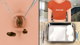 ASMR Satisfying navel stone removal animation‼️