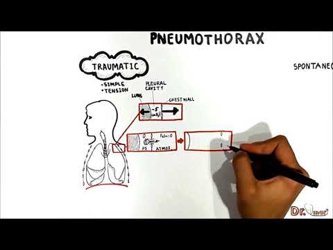 Pneumothorax