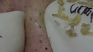 Loan Nguyen Acne Treatment 27c