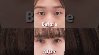 #美容 #美容整形 #埋没法 #二重埋没 #埋没
