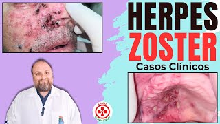 Herpes Zoster | Varicela Zoster
