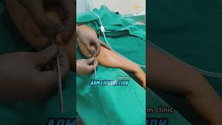 Arm Liposuction Transformation | Sculpted & Toned Arms! #fatloss #weightloss #ytshorts