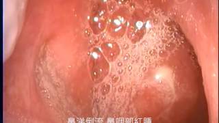 鼻涕倒流 慢性咳嗽 鼻咽內視鏡檢查 PND & chronic cough, fiberscopy exam.