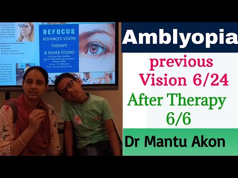 vision 6/24 to 6/6 Successful Treatment of Amblyopia just 30 Sessions ।Refocus Vision Therapy।