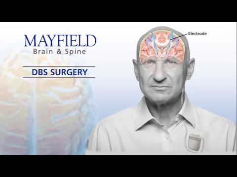 Mayfield Minute: Deep Brain Stimulation (DBS)