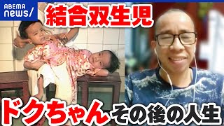 【ベトちゃんドクちゃん】分離手術と兄の死去から37年…その後の暮らしは？結合双生児｜アベプラ