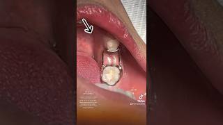 Space maintainer, baby tooth#viral #dentist #youtubeshorts #oralhealth #baby #babytooth #trending#fy